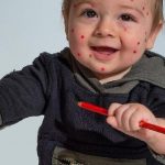 Дізнайтеся, які симптоми вітрянки, як проходить лікування у дітей і дорослих, та чи допомагають народні методи. Практичні поради і важливі застереження.