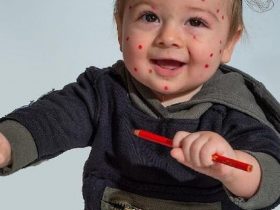 Дізнайтеся, які симптоми вітрянки, як проходить лікування у дітей і дорослих, та чи допомагають народні методи. Практичні поради і важливі застереження.