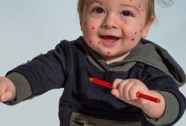 Дізнайтеся, які симптоми вітрянки, як проходить лікування у дітей і дорослих, та чи допомагають народні методи. Практичні поради і важливі застереження.