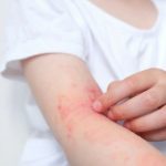 Дізнайтесь, як відрізнити укус клопа, чим лікувати ураження та як швидко зняти почервоніння після укусу. Практичні поради для безпечного та ефективного догляду.