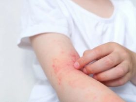 Дізнайтесь, як відрізнити укус клопа, чим лікувати ураження та як швидко зняти почервоніння після укусу. Практичні поради для безпечного та ефективного догляду.