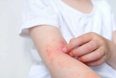 Дізнайтесь, як відрізнити укус клопа, чим лікувати ураження та як швидко зняти почервоніння після укусу. Практичні поради для безпечного та ефективного догляду.